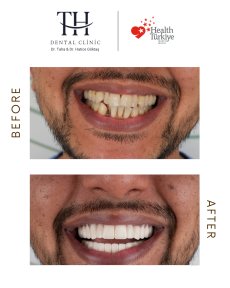 All-on-4 dental implants before and after results at TH Dental Clinic, smile transformation