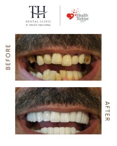 Before and after All-on-4 dental implants result at TH Dental Clinic – full smile restoration