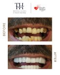 Before and after All-on-4 dental implants result at TH Dental Clinic – full smile restoration
