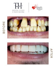 Before and after All-on-4 dental implants result at TH Dental Clinic – smile transformation
