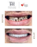 Before and after All-on-4 dental implants result at TH Dental Clinic – smile restoration