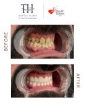 Before and after All-on-4 dental implants result at TH Dental Clinic – improved smile aesthetics