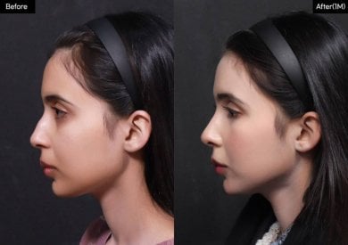 before-after photo rhinoplasty-nose-job