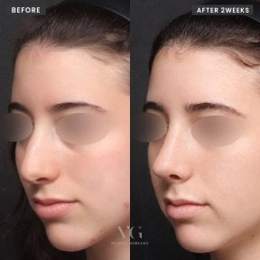 before-after photo rhinoplasty-nose-job