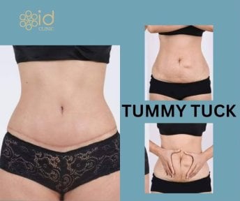 before-after photo mastopexy-breast-lift-contour-plastics