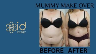before-after photo mastopexy-breast-lift-contour-plastics