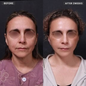 Resultados de lifting de cuello antes y después en VG Plastic Surgery – piel más firme tras 2 semanas