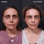 Resultados de lifting de cuello antes y después en VG Plastic Surgery – piel más firme tras 2 semanas