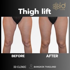 Vorher-nachher-Ergebnis Oberschenkelstraffung bei ID Clinic Bangkok, verbesserte Kontur