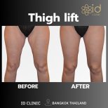 Vorher-nachher-Ergebnis Oberschenkelstraffung bei ID Clinic Bangkok, verbesserte Kontur