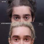 Resultados de lifting facial antes y después en VG Plastic Surgery – mejora visible en frente y cejas