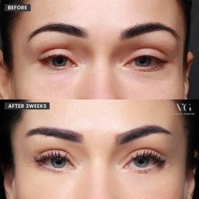 Resultados de blefaroplastia antes y después en VG Plastic Surgery, mejora en 3 semanas