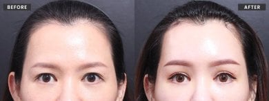 Resultados de lifting facial antes y después en VG Plastic Surgery – rejuvenecimiento visible