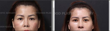 Resultados de lifting facial antes y después en VG Plastic Surgery – rejuvenecimiento visible