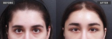 Resultados de lifting facial antes y después en VG Plastic Surgery – rejuvenecimiento visible