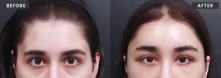Resultados de lifting facial antes y después en VG Plastic Surgery – rejuvenecimiento visible