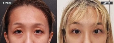Resultados de lifting facial antes y después en VG Plastic Surgery – rejuvenecimiento visible