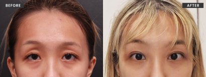 Resultados de lifting facial antes y después en VG Plastic Surgery – rejuvenecimiento visible