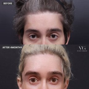 Resultados de lifting facial antes y después en VG Plastic Surgery, mejora visible en la frente