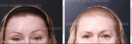 Resultados de lifting facial antes y después en VG Plastic Surgery – mejora visible en frente y cejas