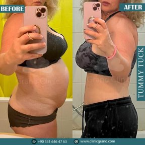 Результаты до и после абдоминопластики в Grand Clinic – улучшение контура живота