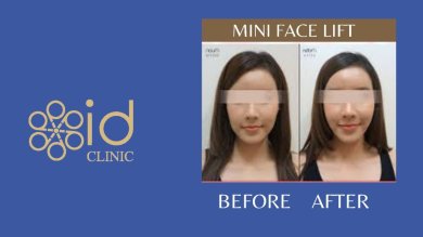before-after photo otoplasty-ear-surgery