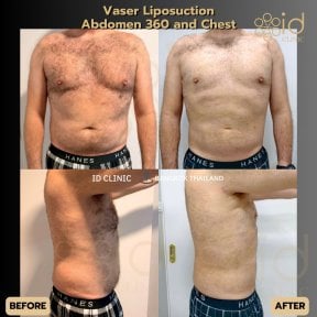 before-after photo 360-liposuction