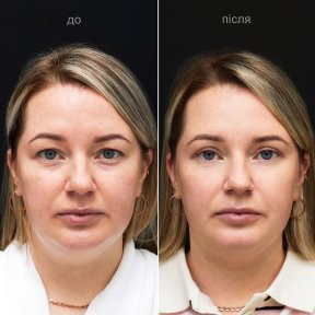 before-after photo plastika-niznego-veka