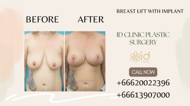 before-after photo abdominoplasty