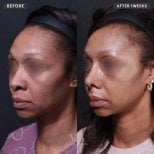 Before and after rhinoplasty results at VG Plastic Surgery, nose reshaping after 1 week