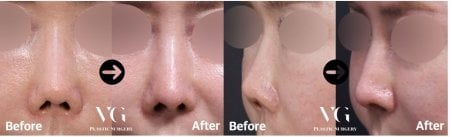 Before and after rhinoplasty results at VG Plastic Surgery, nose reshaping with natural look