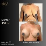 Результати збільшення грудей 450cc в ID Clinic Bangkok, фото до і після