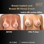 Результати до і після збільшення та підтяжки грудей в ID Clinic Bangkok, імпланти 400cc