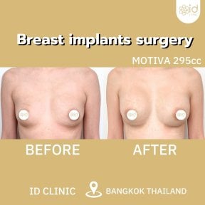 Результати до і після збільшення грудей в ID Clinic Bangkok з імплантами Motiva 295cc