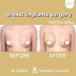 Результати до і після збільшення грудей в ID Clinic Bangkok з імплантами Motiva 295cc