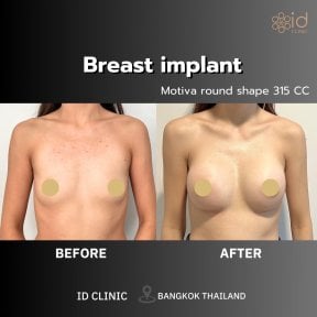 Результати до і після збільшення грудей в ID Clinic Bangkok з імплантами Motiva 315cc