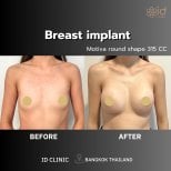 Результати до і після збільшення грудей в ID Clinic Bangkok з імплантами Motiva 315cc