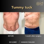 Результати до і після абдомінопластики в ID Clinic Bangkok, покращення контуру живота