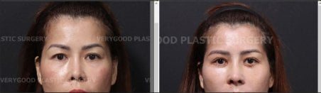 Avant-après implants malaire chez VG Plastic Surgery, volume et contour des joues améliorés