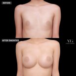 Before and after breast augmentation results at VG Plastic Surgery, enhanced breast volume