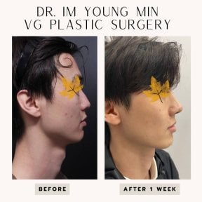 Before and after rhinoplasty result at VG Plastic Surgery, improved nose profile after 1 week