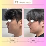 Before and after rhinoplasty results at VG Plastic Surgery, improved nose profile for men