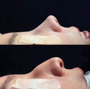 Before and after rhinoplasty results at Renaissance Clinic, nose reshaping with natural look