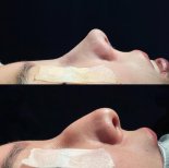 Before and after rhinoplasty results at Renaissance Clinic, nose reshaping with natural look