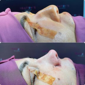 Before and after rhinoplasty results at Renaissance Clinic, improved nose shape and profile