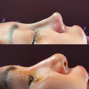 Before and after rhinoplasty results at Renaissance Clinic, improved nose shape and profile