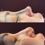 Before and after rhinoplasty results at Renaissance Clinic, improved nose shape and profile