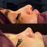 Before and after open rhinoplasty results at Renaissance Clinic, improved nose profile