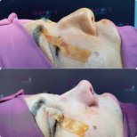Before and after open rhinoplasty results at Renaissance Clinic, improved nose shape visible