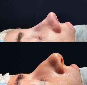Before and after open rhinoplasty results at Renaissance Clinic, improved nose profile